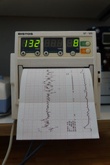 CTG - Kardiotokografie